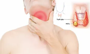 Ai có nguy cơ mắc ung thư tuyến giáp?